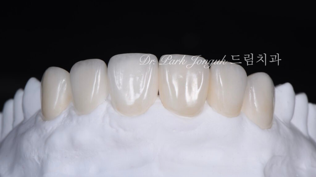 앞니 라미네이트