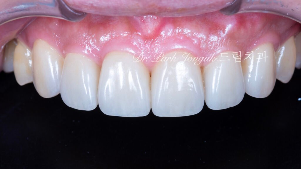 앞니 라미네이트