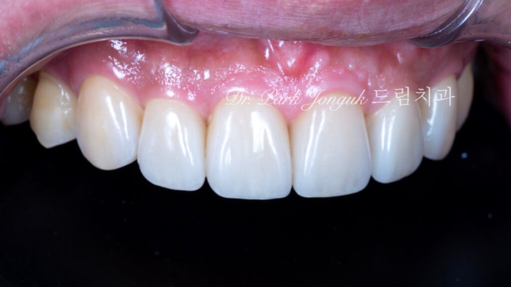 앞니 라미네이트