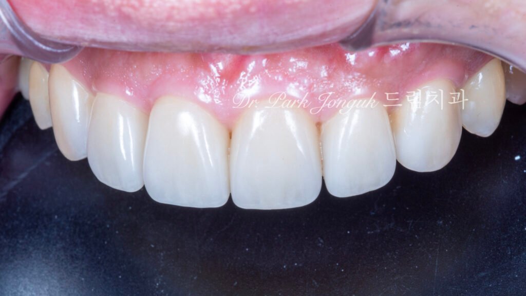 앞니 라미네이트