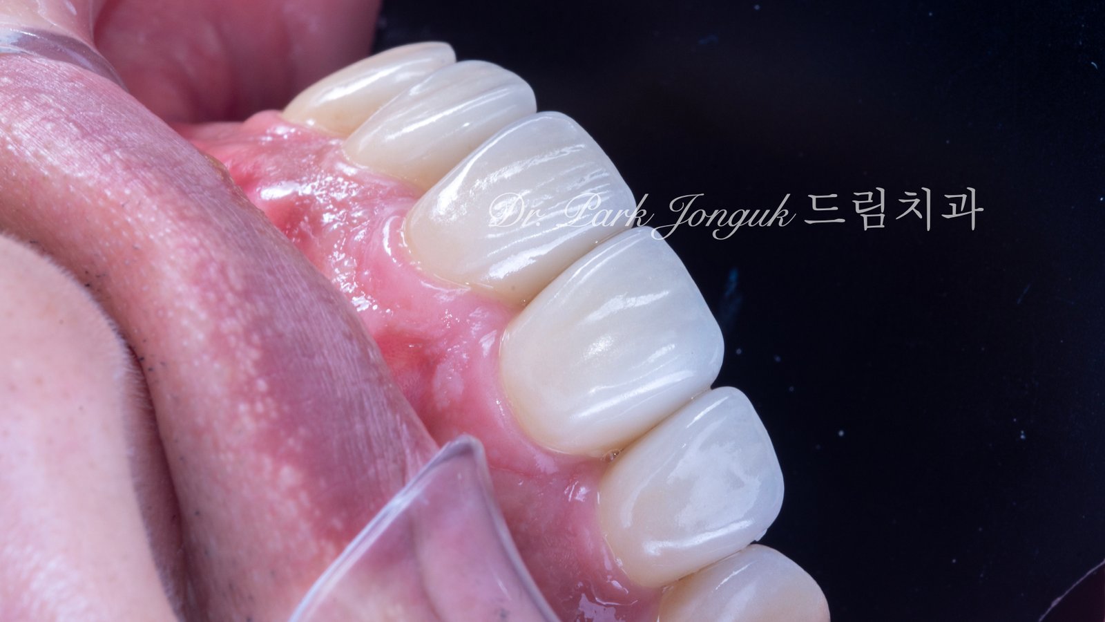 앞니 라미네이트