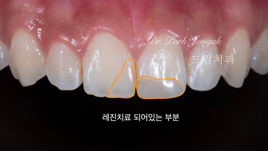 강남 앞니 레진 라미네이트 재시술