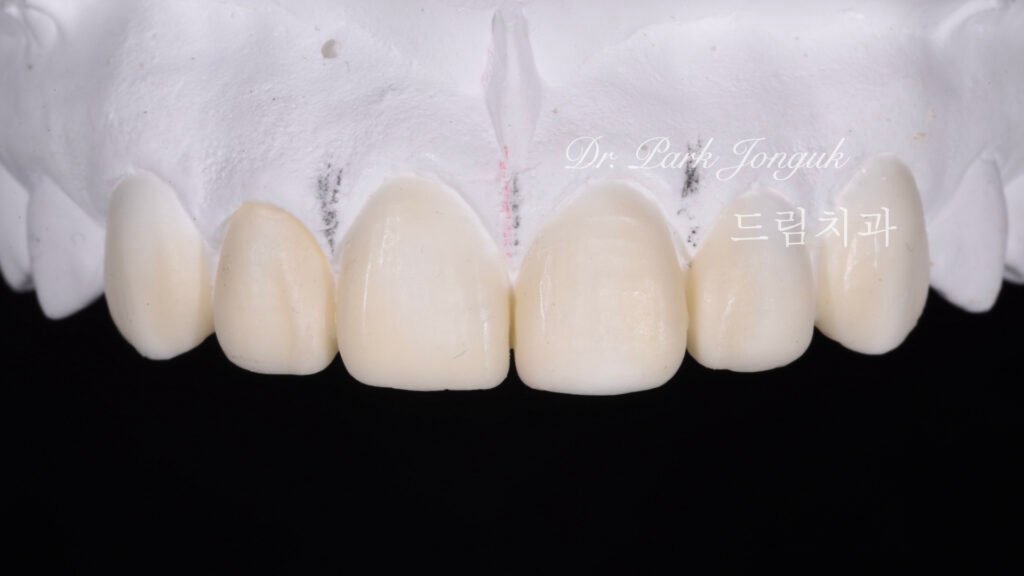 강남 앞니 레진 라미네이트 재시술