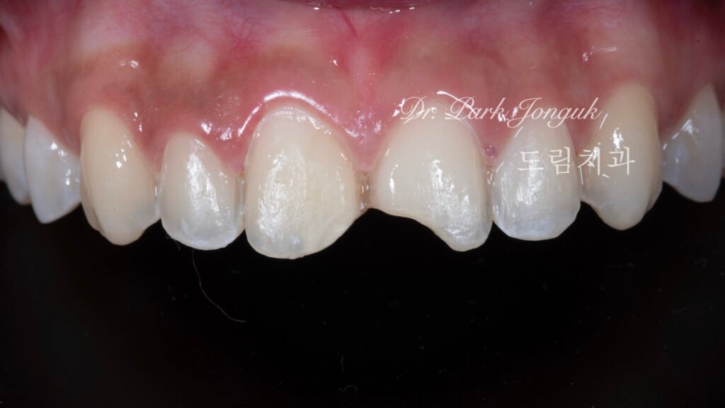 강남 앞니 레진 라미네이트 재시술