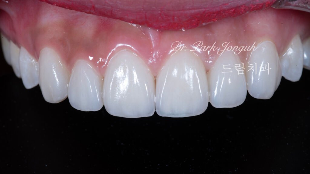 강남 앞니 레진 라미네이트 재시술