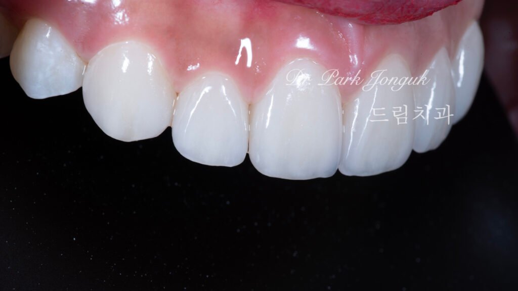 강남 앞니 레진 라미네이트 재시술