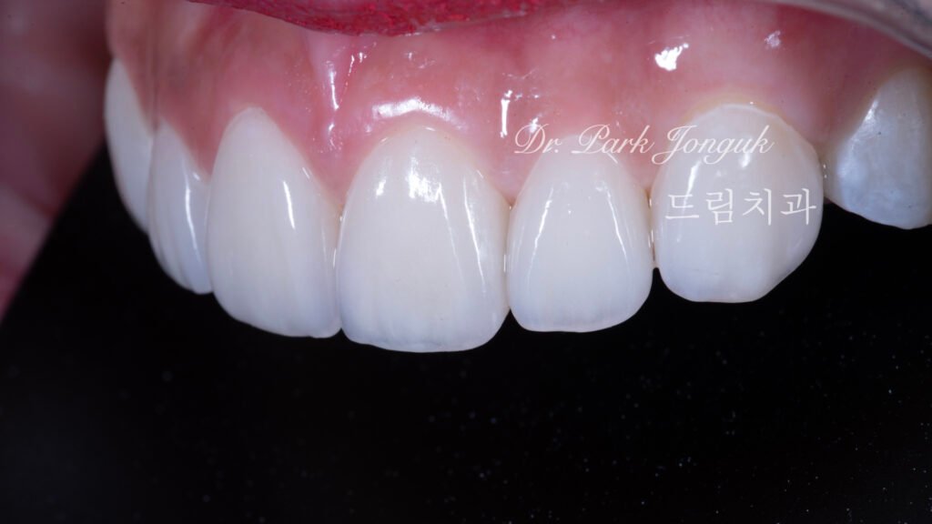 강남 앞니 레진 라미네이트 재시술