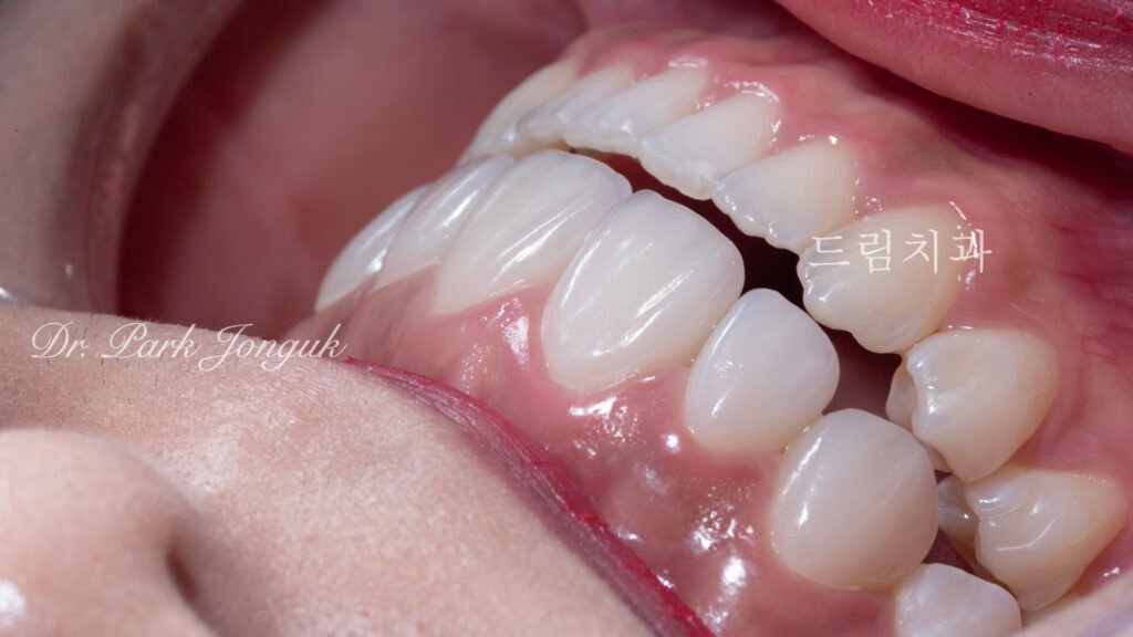 강남 앞니 레진 라미네이트 재시술