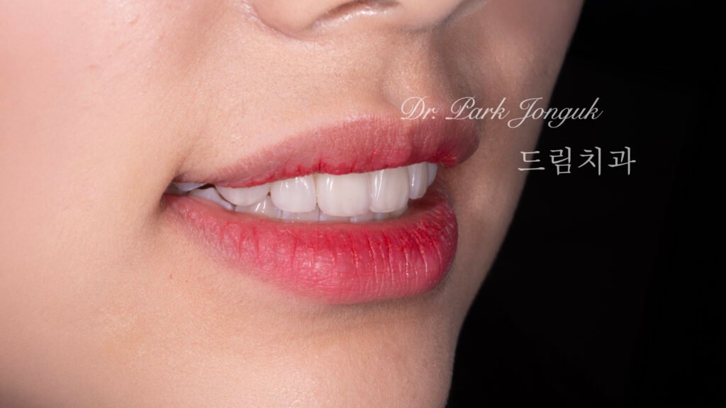 강남 앞니 레진 라미네이트 재시술
