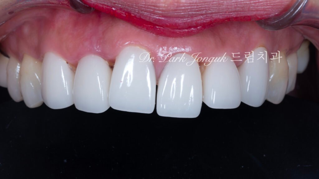 라미네이트 재시술
