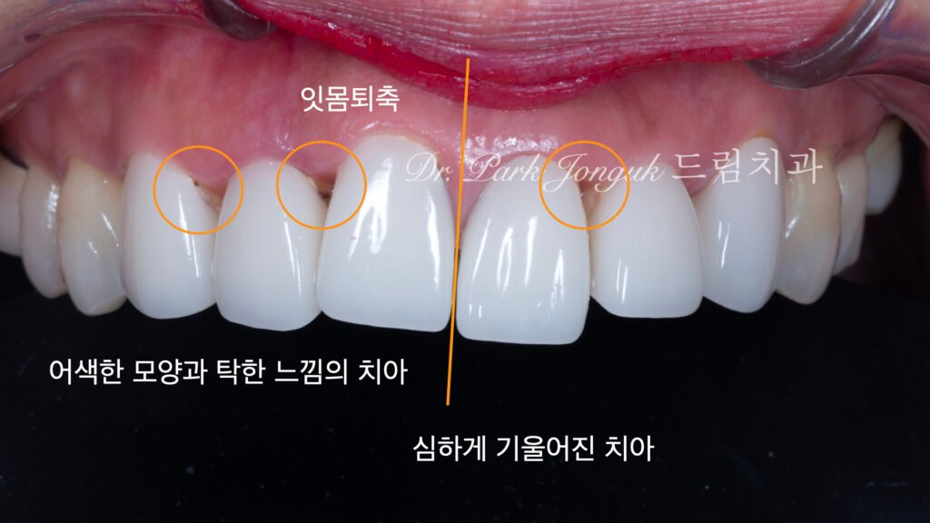 라미네이트 재시술