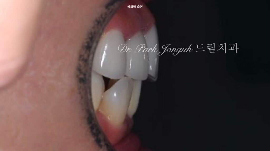 라미네이트 재시술