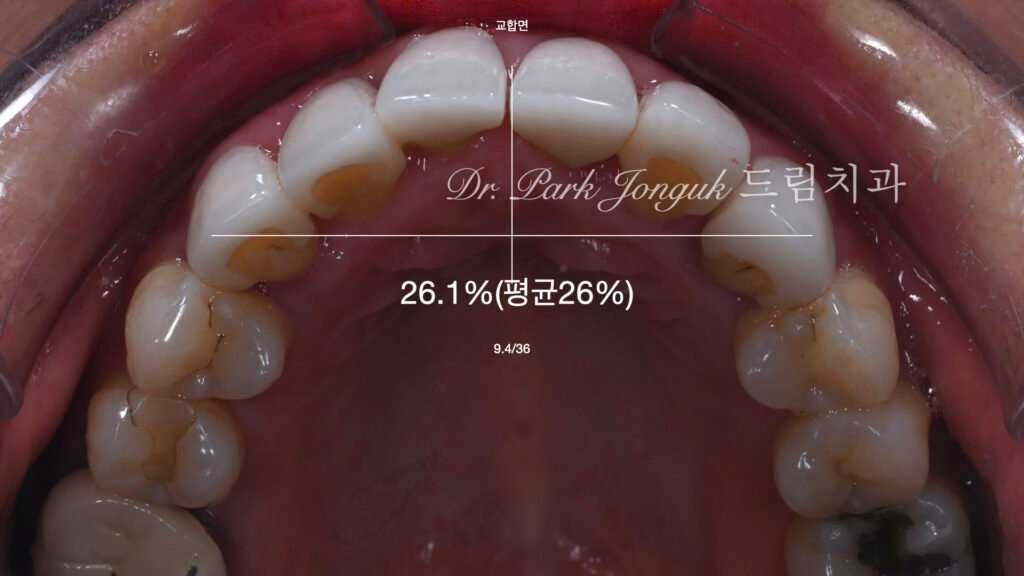 라미네이트 재시술