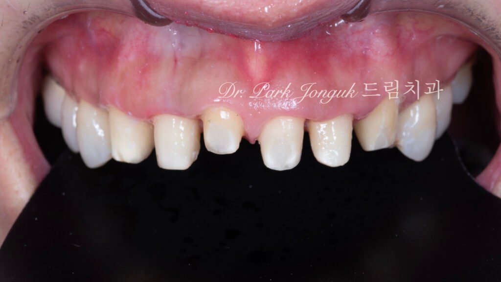 라미네이트 재시술