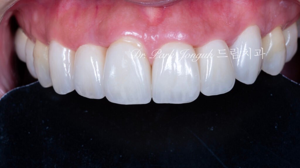 라미네이트 재시술