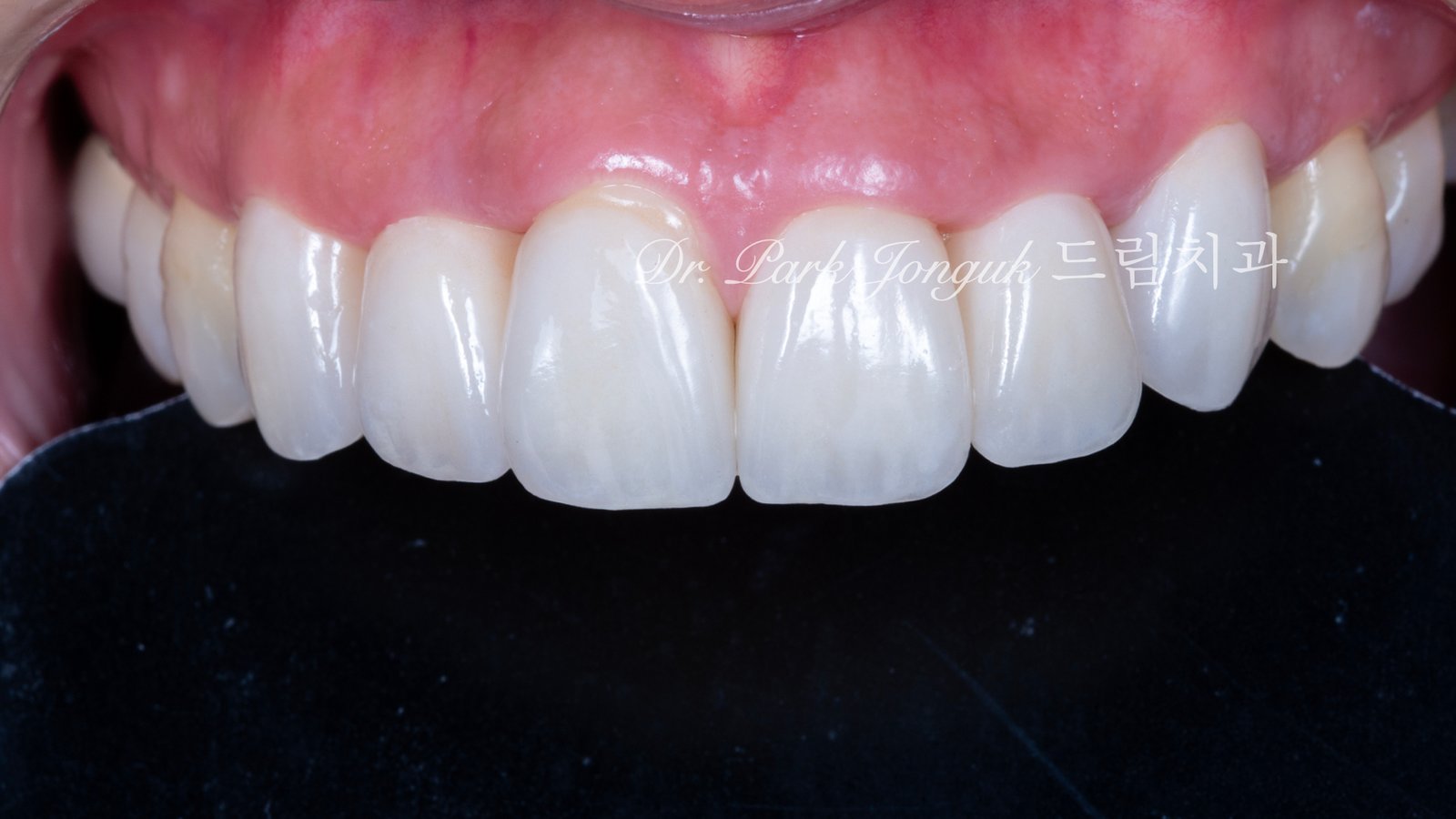 라미네이트 재시술