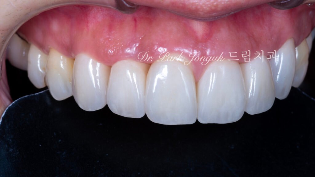 라미네이트 재시술