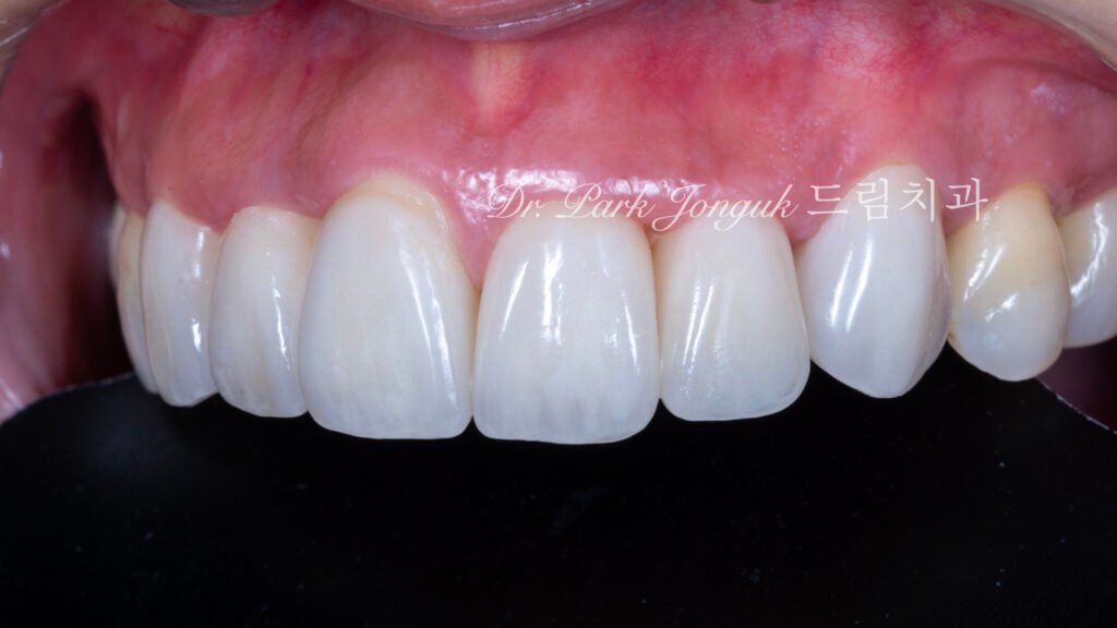 라미네이트 재시술