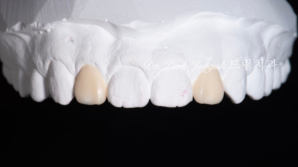 교정후 왜소치 앞니 두개 무삭제 라미네이트