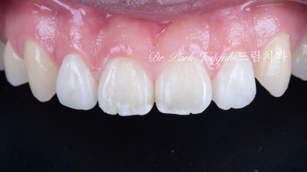 교정후 왜소치 앞니 두개 무삭제 라미네이트