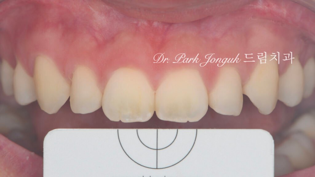 교정후 왜소치 앞니 두개 무삭제 라미네이트