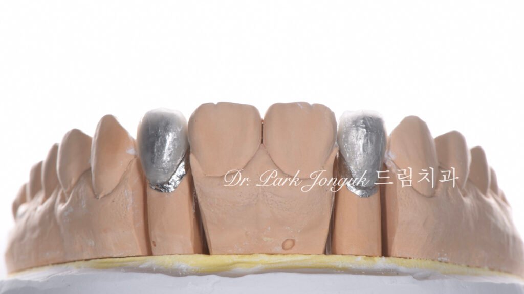 교정후 왜소치 앞니 두개 무삭제 라미네이트