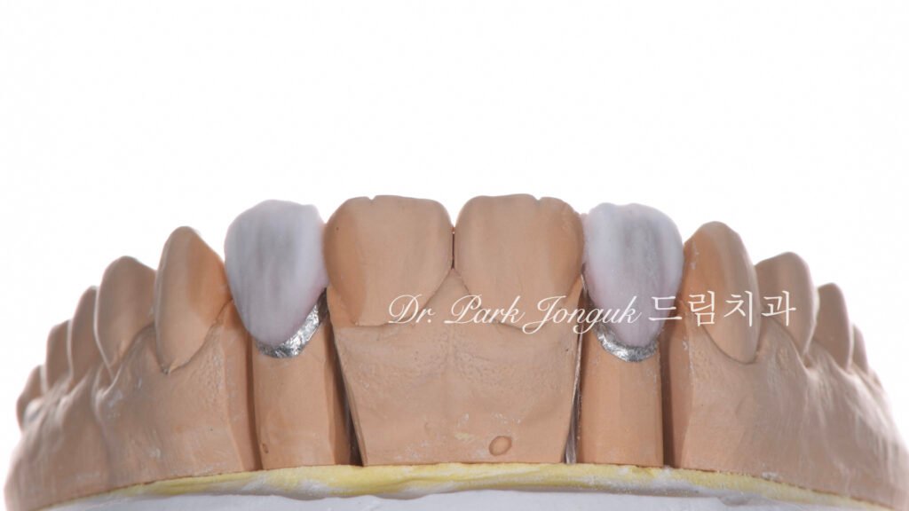 교정후 왜소치 앞니 두개 무삭제 라미네이트