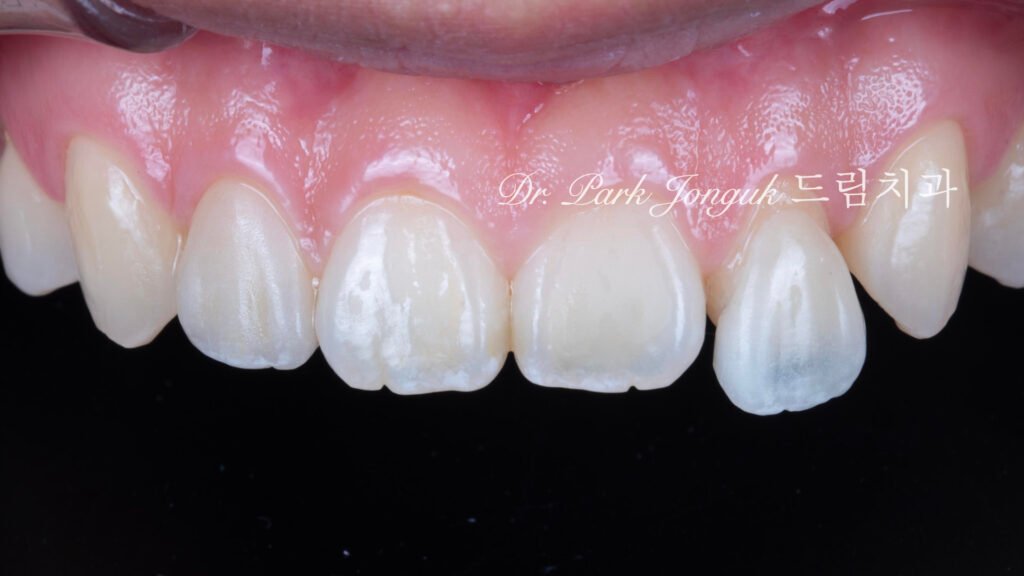 교정후 왜소치 앞니 두개 무삭제 라미네이트