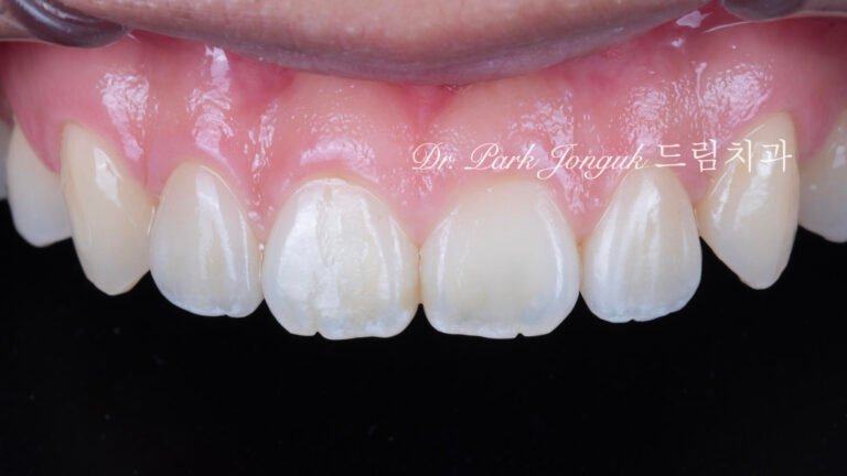 교정후 왜소치 앞니 두개 무삭제 라미네이트