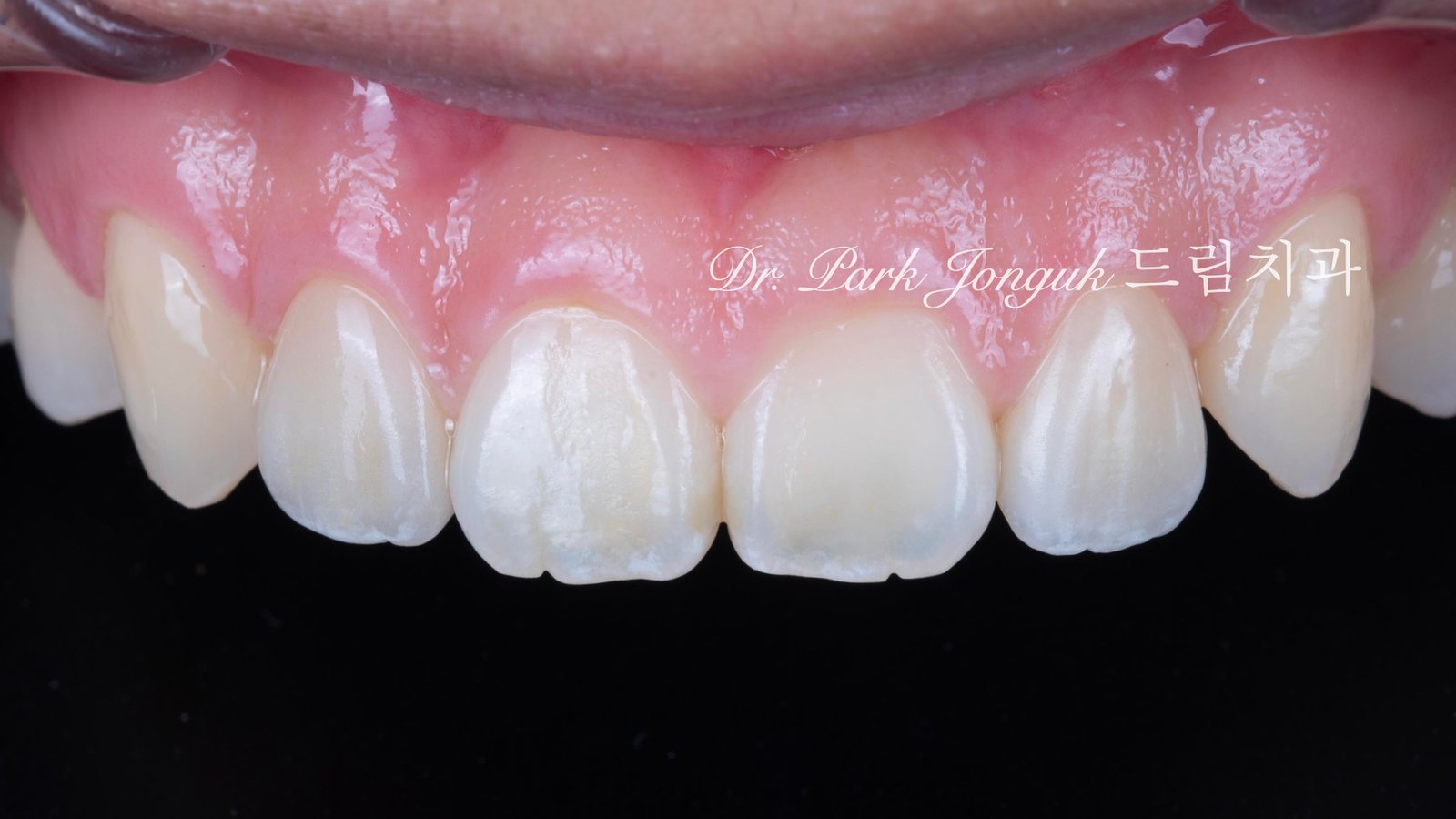 교정후 왜소치 앞니 두개 무삭제 라미네이트