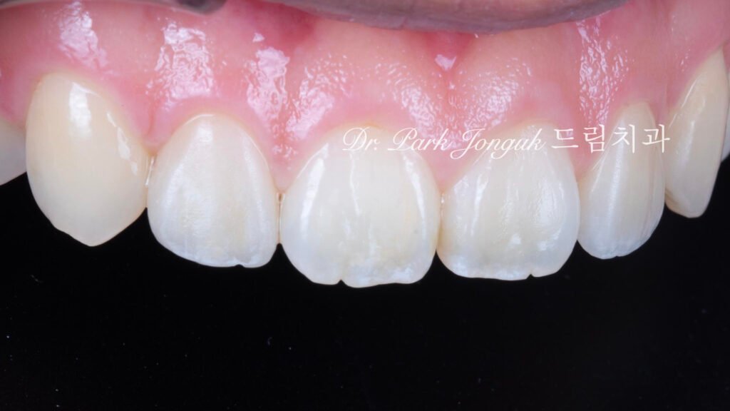 교정후 왜소치 앞니 두개 무삭제 라미네이트