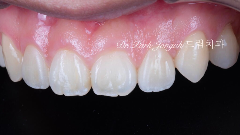 교정후 왜소치 앞니 두개 무삭제 라미네이트
