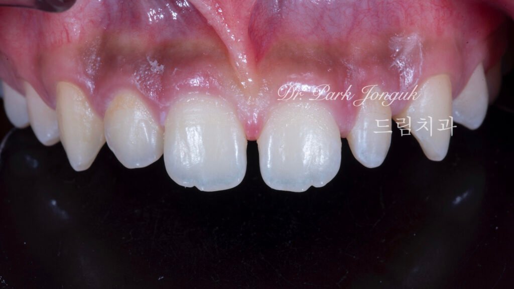 왜소치 무삭제 라미네이트