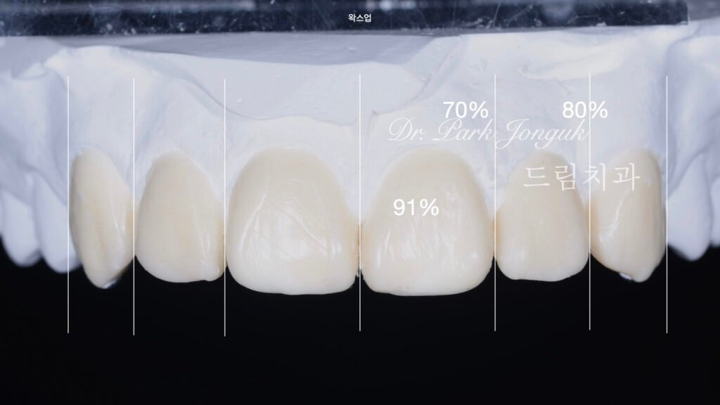 왜소치 무삭제 라미네이트