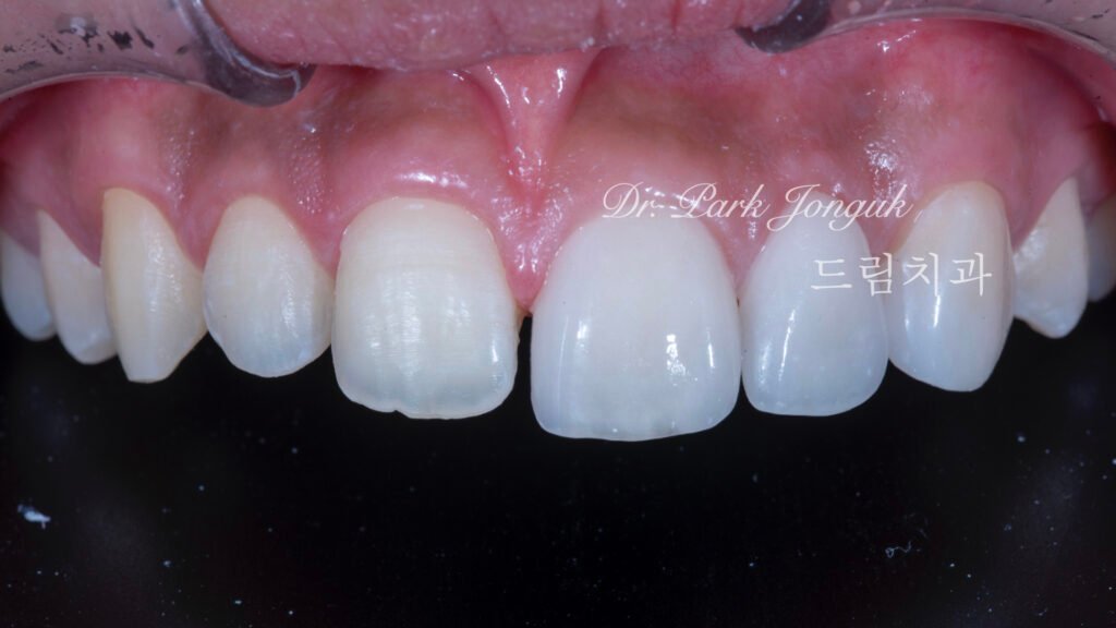 왜소치 무삭제 라미네이트