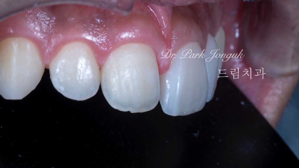 왜소치 무삭제 라미네이트