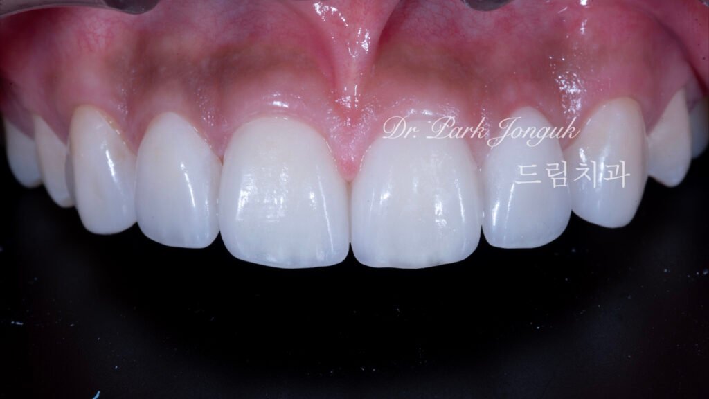 왜소치 무삭제 라미네이트