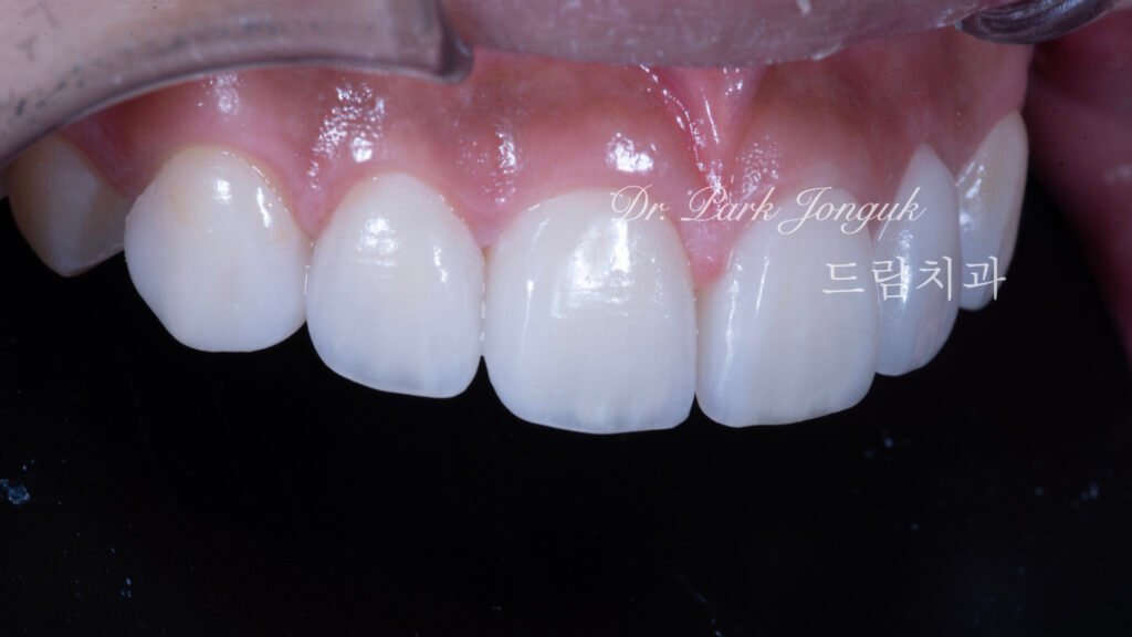 왜소치 무삭제 라미네이트