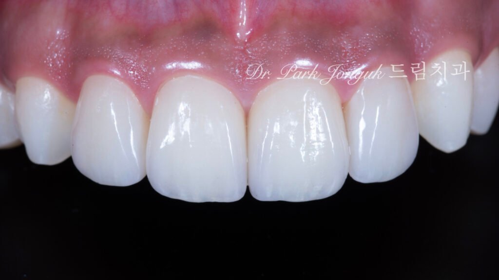 왜소치 라미네이트