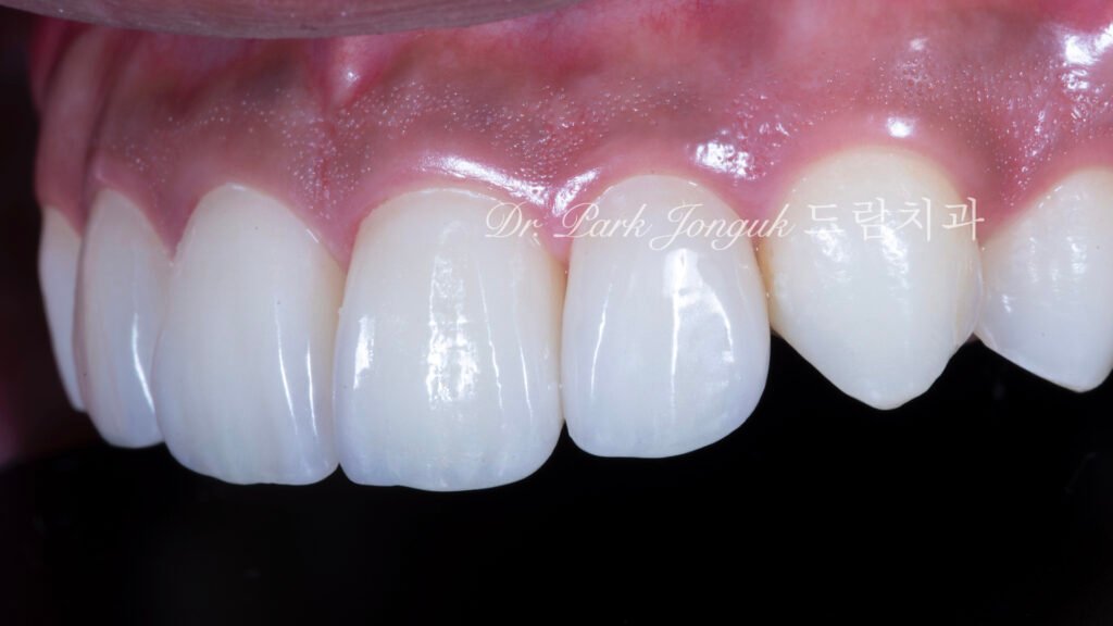 왜소치 라미네이트