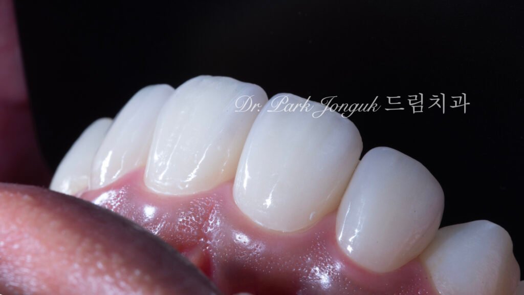 왜소치 라미네이트