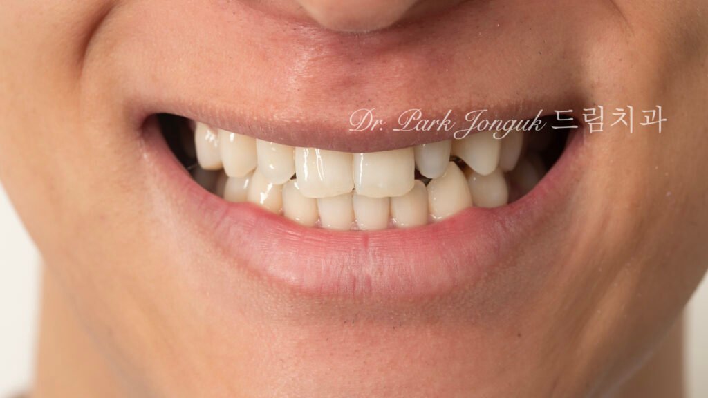 왜소치 라미네이트