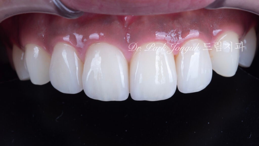 왜소치 라미네이트