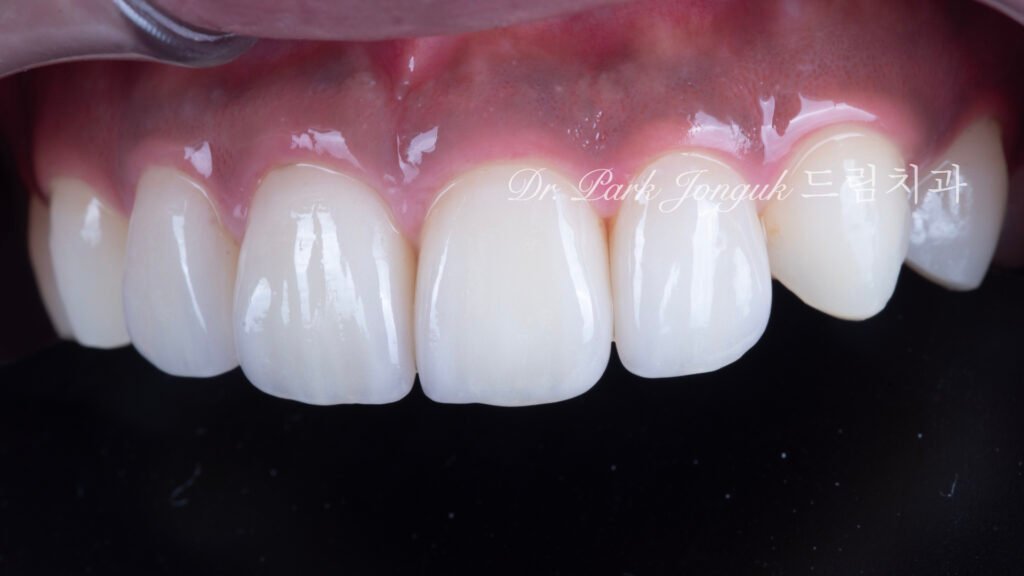 왜소치 라미네이트
