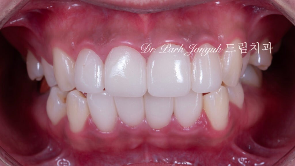앞니 라미네이트 재시술