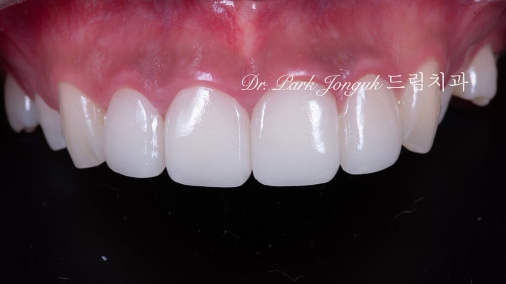 앞니 라미네이트 재시술