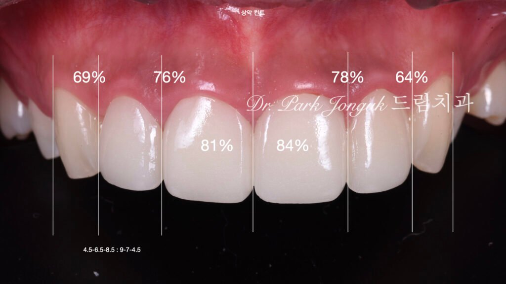 앞니 라미네이트 재시술