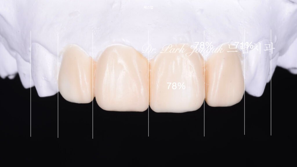 앞니 라미네이트 재시술