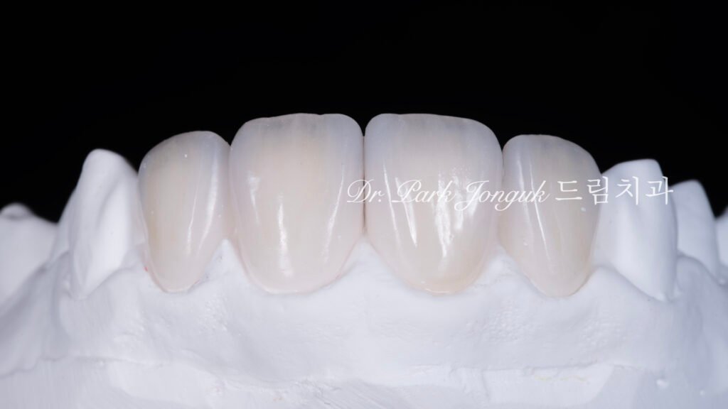 앞니 라미네이트 재시술