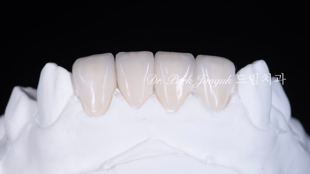 앞니 라미네이트 재시술